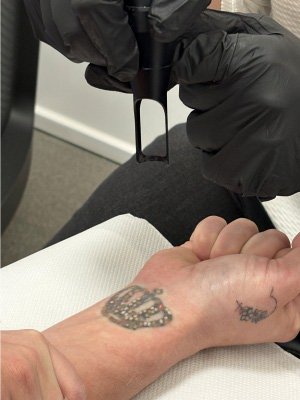 Tattoo removal Limburg Tattoo removal Limburg
