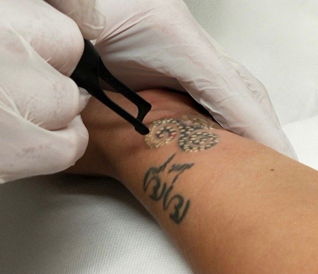Tattoo removal Limburg Tattoo removal Limburg