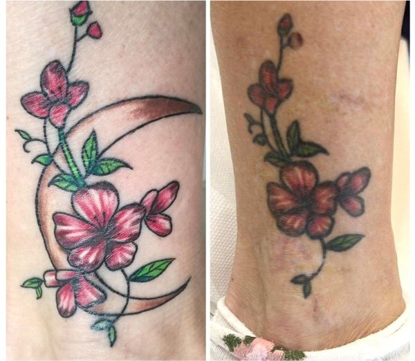 Voorbeelden van het tattoo verwijderingsproces