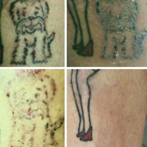 Voorbeelden van het tattoo verwijderingsproces Voorbeelden van het tattoo verwijderingsproces
