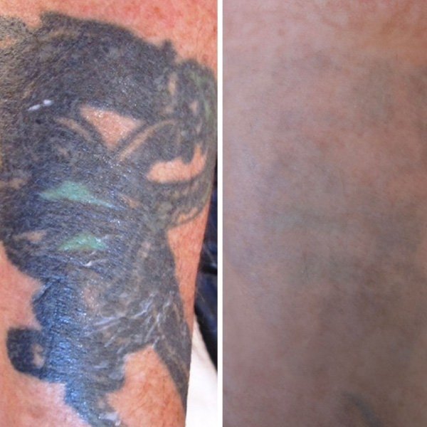 Voorbeelden van het tattoo verwijderingsproces Voorbeelden van het tattoo verwijderingsproces