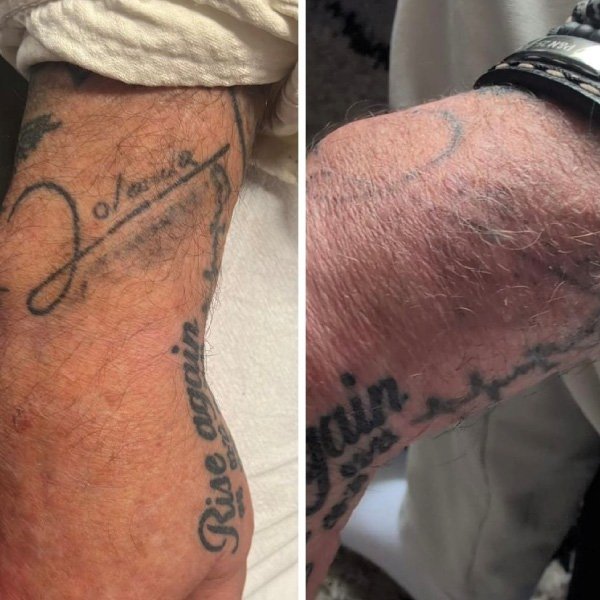 Voorbeelden van het tattoo verwijderingsproces Voorbeelden van het tattoo verwijderingsproces