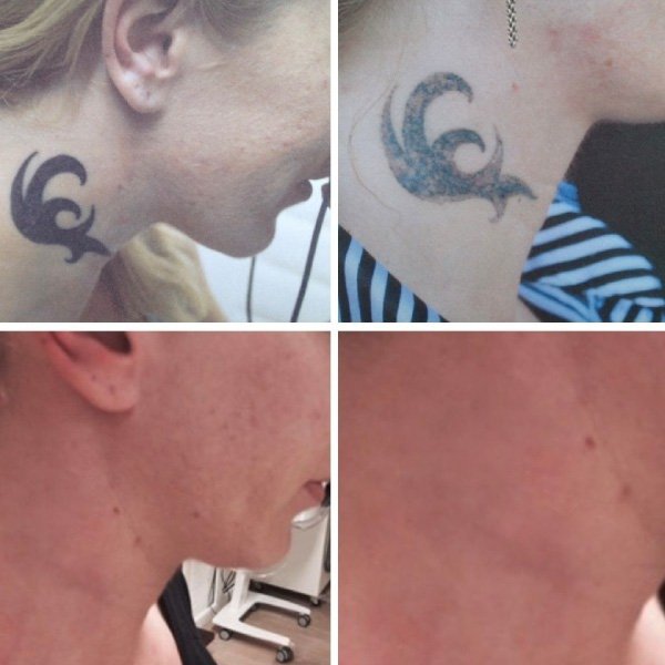 Voorbeelden van het tattoo verwijderingsproces Voorbeelden van het tattoo verwijderingsproces