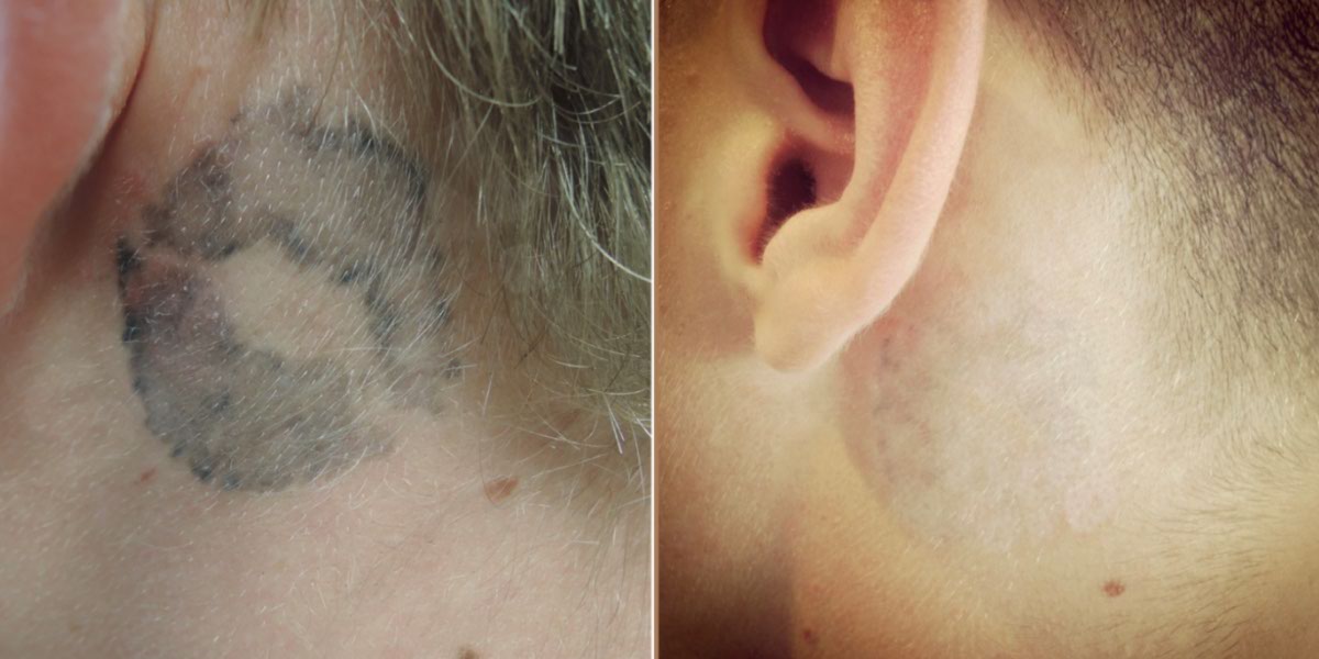Voorbeelden van het tattoo verwijderingsproces Voorbeelden van het tattoo verwijderingsproces